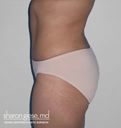 abdominoplasty after picture